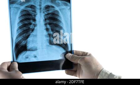 Rayons X des poumons humains isolés sur blanc, dans les mains d'un médecin une image des poumons, pneumonie Banque D'Images
