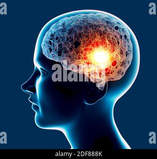 Douleur dans la tête, le cerveau et les synapses, problèmes cognitifs, déficit mental. Anévrisme. Maladies dégénératives affectant la région du cerveau. Parkinson Banque D'Images