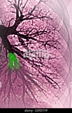 Embolie pulmonaire dans le lobe inférieur gauche (artère pulmonaire bloquée par un caillot de sang). Angiographie thoracique. Banque D'Images