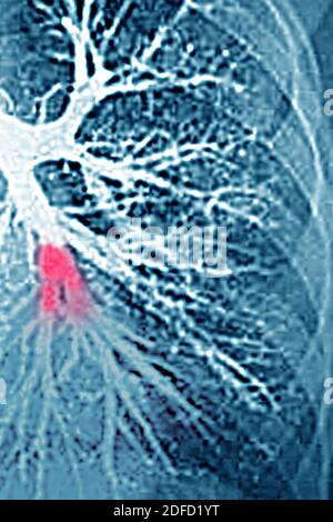 Embolie pulmonaire dans le lobe inférieur gauche (artère pulmonaire bloquée par un caillot de sang). Angiographie thoracique. Banque D'Images