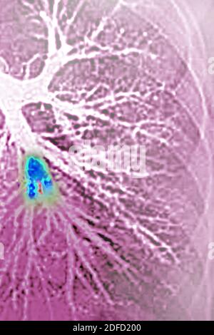 Embolie pulmonaire dans le lobe inférieur gauche (artère pulmonaire bloquée par un caillot de sang). Angiographie thoracique. Banque D'Images