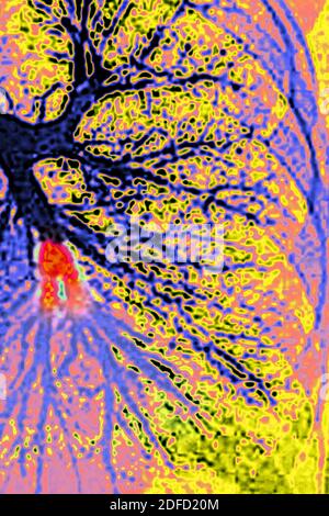 Embolie pulmonaire dans le lobe inférieur gauche (artère pulmonaire bloquée par un caillot de sang). Angiographie thoracique. Banque D'Images