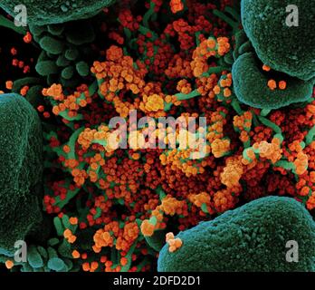 Micrographe électronique à balayage colorisé d'une cellule apoptotique (verte) fortement infectée par des particules du virus du COV-SRAS (orange), isolée d'un patient Banque D'Images