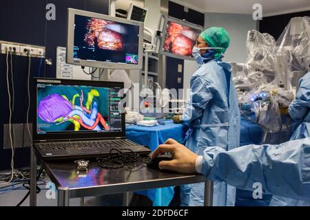 La chirurgie rénale conservatrice robotique guidée par l'image assistée par la modélisation 3D, cette modélisation 3D du rein avec sa tumeur située en violet, guide les s. Banque D'Images