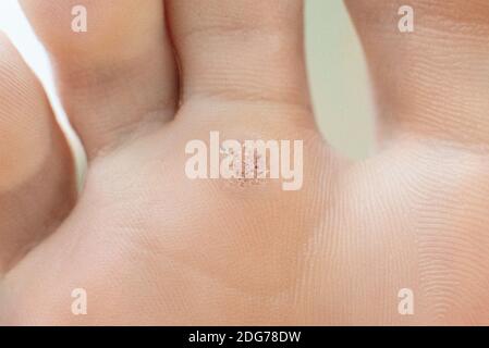 voila sur un gros plan émoussé. Photo macro du papillome humain sur le pied Banque D'Images