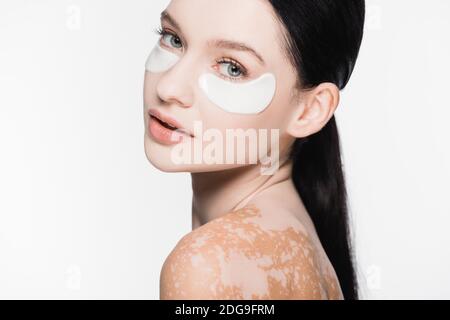 jeune belle femme avec le vitiligo et les yeux patchs sur le visage isolé sur blanc Banque D'Images