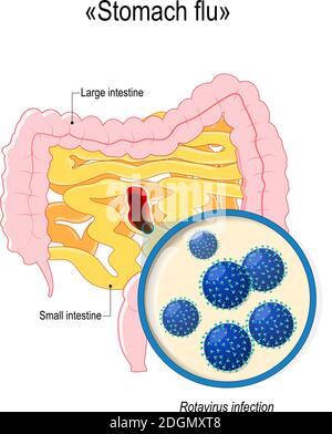 infection à rotavirus ou grippe gastrique. Intestin grêle, côlon et gros plan des virions à rotavirus. Anatomie humaine. Diagramme vectoriel pour votre conception Illustration de Vecteur