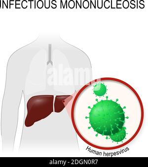 la mononucléose infectieuse. silhouette humaine avec foie de lumière, et les virus qui causent cette maladie. Virus Epstein-Barr. Illustration de Vecteur