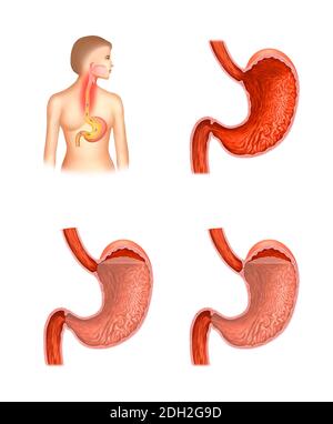 Illustration anatomique de l'estomac et de la maladie de reflux oesophagien Banque D'Images