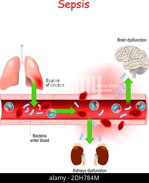 Septicémie. Gros plan de la coupe transversale d'un vaisseau sanguin présentant une infection bactérienne. La septicémie est une maladie qui met la vie en danger. Effets de la septicémie. Vecteur Illustration de Vecteur