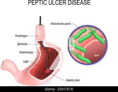 Ulcère peptique (PUD), ulcère gastrique ou ulcère gastrique. Estomac humain avec endoscope et vue rapprochée de la bactérie Helicobacter pylori Illustration de Vecteur