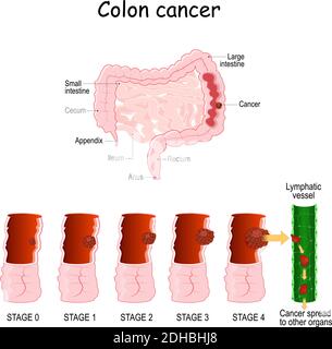 cancer du côlon. Oncologie colorectal. Développement d'une tumeur maligne de 0 à 4 étapes. Schéma médical. Illustration vectorielle. Système digestif. Illustration de Vecteur