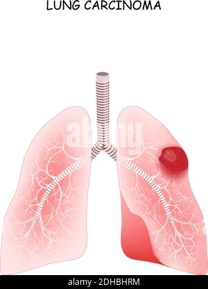 Cancer du poumon. Carcinome est une tumeur maligne du poumon. Illustration vectorielle à usage médical Illustration de Vecteur