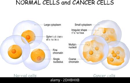 Cellules cancéreuses et cellules normales. Comparaison et différence entre les tissus sains et la tumeur. Détails sur la chromatine, le noyau et le cytoplasme. Illustration de Vecteur
