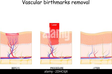 Suppression des marques de naissance vasculaires. Avant et après la procédure de traitement. Chirurgie au laser pour la peau Illustration de Vecteur