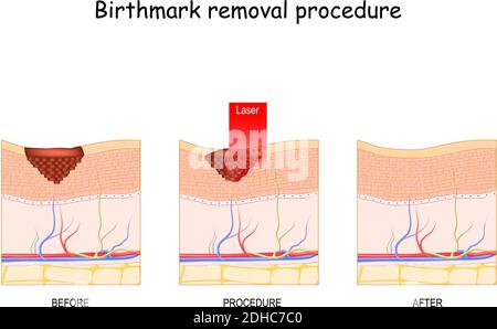 Suppression du laser de marque de naissance. Traitement. Avant et après la procédure Illustration de Vecteur