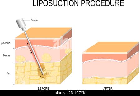 procédure de liposuccion. Avant et après. Modélisation et chirurgie de la graisse. Schéma vectoriel à usage scientifique et médical Illustration de Vecteur