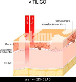 Vitiligo. Est un état de peau caractérisé par des parties de la peau perdant leur pigment. Il se produit lorsque les cellules pigmentaires de la peau (mélanocytes) Illustration de Vecteur