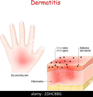 Dermatite. Eczéma atopique. Gros plan de la coupe transversale de la peau humaine avec la dermatite. Pénétration des allergènes. Illustration vectorielle Illustration de Vecteur