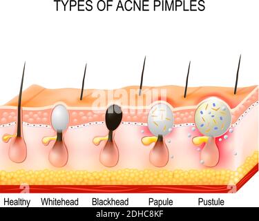 Types de boutons d'acné. Une peau saine, des têtes blanches et des têtes noires, des papules et des pustules Illustration de Vecteur