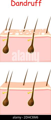 Les pellicules sur les cheveux avant et après le traitement. La dermatite séborrhéique peut se produire en raison de la peau sèche, des bactéries et des champignons sur le cuir chevelu Illustration de Vecteur