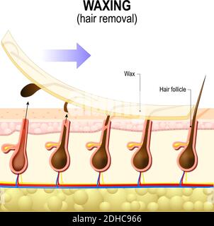 Épilation. La cire est une forme d'épilation semi-permanente qui enlève les cheveux. Structure de la peau humaine Illustration de Vecteur