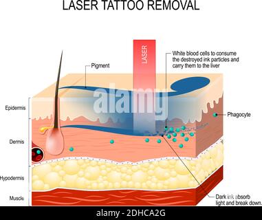 Suppression du tatouage laser. Comment fonctionne le retrait des tatouages laser. L'encre foncée absorbe la lumière et se défait Illustration de Vecteur