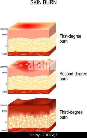 brûlures cutanées. Trois degrés de brûlures. Type de blessure à la peau. Étape de brûlure Illustration de Vecteur