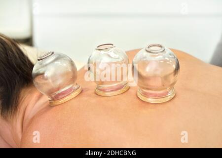 Tasses en verre aspirées sur le dos de la jeune femme - gros plan détail de la thérapie de cupping, forme de médecine alternative Banque D'Images