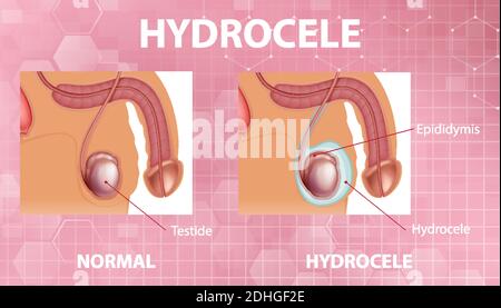 Affiche médicale montrant différents entre le testicule normal mâle et l'hydrocèle illustration Illustration de Vecteur