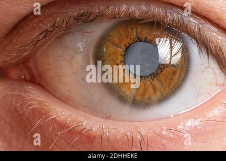 Macro photos de l'œil humain - cataracte assombrissement de la lentille, détérioration de la vision. Traitement de la cataracte, chirurgie et ophtalmologie Banque D'Images