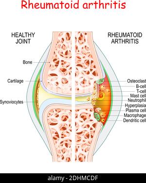 Polyarthrite rhumatoïde. Joint sain et endommagé. Gros plan des os, du cartilage et des cellules dans une capsule articulaire : synoviocytes, ostéoclastes, neutrophiles Illustration de Vecteur
