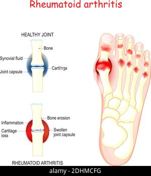 la polyarthrite rhumatoïde dans les articulations du pied humain. comparaison et différence entre les os sains et les articulations avec la polyarthrite rhumatoïde. Vecteur Illustration de Vecteur