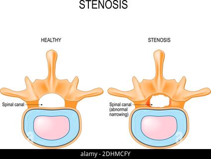 La sténose spinale lombaire est un rétrécissement anormal du canal rachidien. Section de la colonne vertébrale humaine et section transversale de la moelle épinière. Vecteur Illustration de Vecteur
