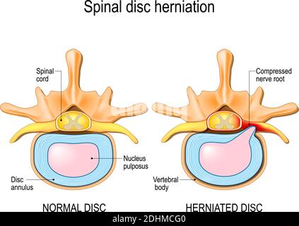 Hernie médullaire. Douleurs dorsales. Hernie à disque normal et à disque spinal dans les vertèbres cervicales. Illustration vectorielle Illustration de Vecteur