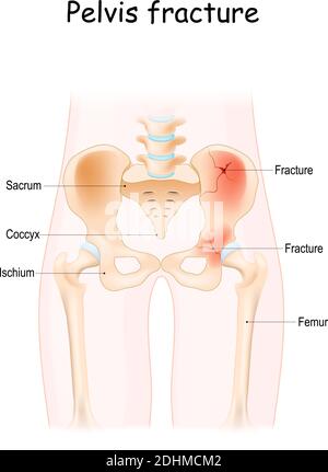 Fracture pelvienne. Os pelviens : sacrum, ilium, coccyx, pubis, ischium et fémur. Illustration vectorielle isolée sur fond blanc Illustration de Vecteur