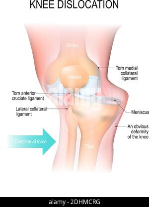 Luxation du genou. Traumatisme latéral au genou, ligaments collatéraux déchirés, lésion du ligament croisé et lésion du ménisque Illustration de Vecteur