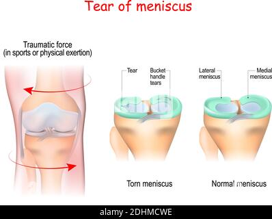 la déchirure d'un ménisque est une rupture d'une ou plusieurs bandes de fibrocartilage dans le genou. L'articulation humaine, et la force traumatique Illustration de Vecteur