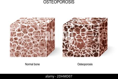 Ostéoporose. Illustration vectorielle pour votre conception et votre usage médical. Différentes vues d'un tissu osseux (normal et ostéoporose). Maladie des os Illustration de Vecteur