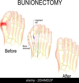 La Bunionectomie est une procédure pour corriger les pathologies et la difformité de l'articulation reliant le gros orteil au pied. Avant et après la chirurgie Illustration de Vecteur