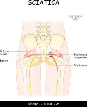 illustration du vecteur médical. sciatique et causes. corps du patient depuis le dos. vue postérieure Illustration de Vecteur