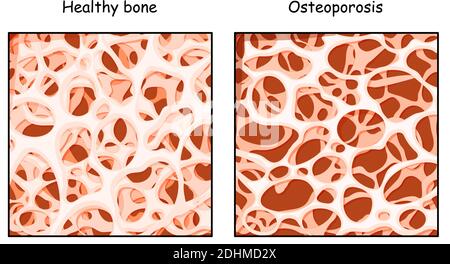 Os sain et Ostéoporose en comparaison isolé sur fond blanc. Maladie des os qui mène à un risque accru de fracture. Faible densité Illustration de Vecteur