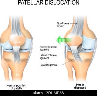 Luxation patellaire. Position normale du genou et de la rotule déplacée. Anatomie du genou Illustration de Vecteur