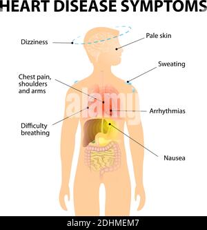 maladie cardiaque : maladie valvulaire, anévrisme, maladie coronarienne, arythmie cardiaque, insuffisance cardiaque, cardiomyopathie et péricardite Illustration de Vecteur