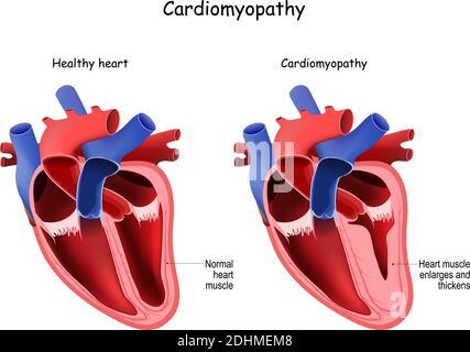Cardiomyopathie. Coeur et coeur sains avec muscle élargi et épaissi. Coupe transversale du coeur humain Illustration de Vecteur
