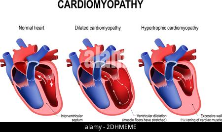 Types de maladies cardiaques : cardiomyopathie hypertrophique et cardiomyopathie dilatée. Coeur et coeur sains avec pathologie. Illustration vectorielle Illustration de Vecteur