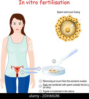 Fécondation in vitro (FIV). Gros plan de la fusion des spermatozoïdes et des ovules. Retirer un ovule des ovaires de la femme Illustration de Vecteur