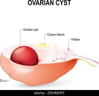 Kyste ovarien Un sac rempli de liquide dans l'ovaire. Illustration de Vecteur