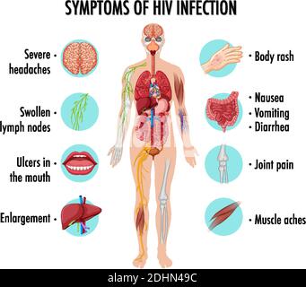 Illustration de l'infographie sur les symptômes de l'infection à VIH Illustration de Vecteur