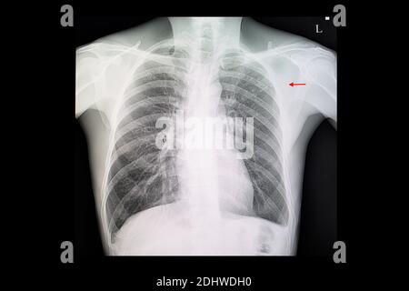 Film radiographique thoracique d'un patient atteint de tuberculose pulmonaire avec infiltration fibronodulaire au niveau du poumon supérieur gauche. Banque D'Images